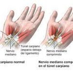 tunel-carpiano-diariojuridico