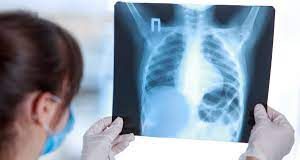 Colombia – Senado busca mejorar tratamiento de tuberculosis Colombia – Senado busca mejorar tratamiento de tuberculosis