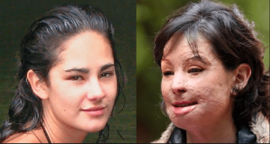 México –  IBD advierte sobre los ataques con ácido a mujeres y su impunidad México –  IBD advierte sobre los ataques con ácido a mujeres y su impunidad